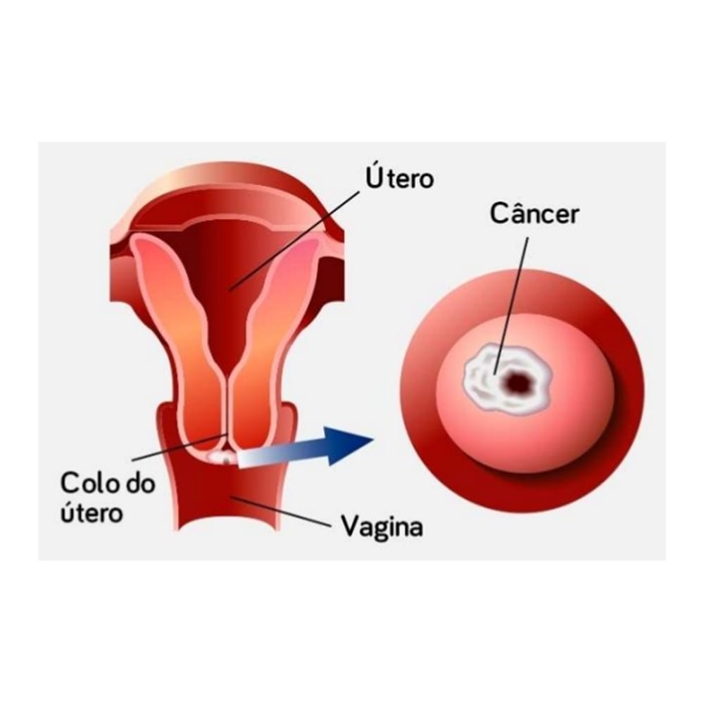 Imagem representativa câncer do colo do útero.