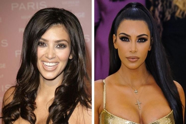 Kim Kardashian Harmonização orofacial