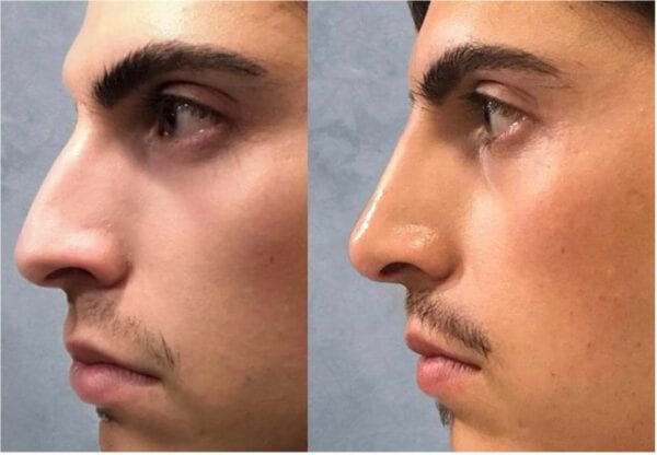 Antes e depois - Rapaz com preenchimento de ácido hialurônico no nariz