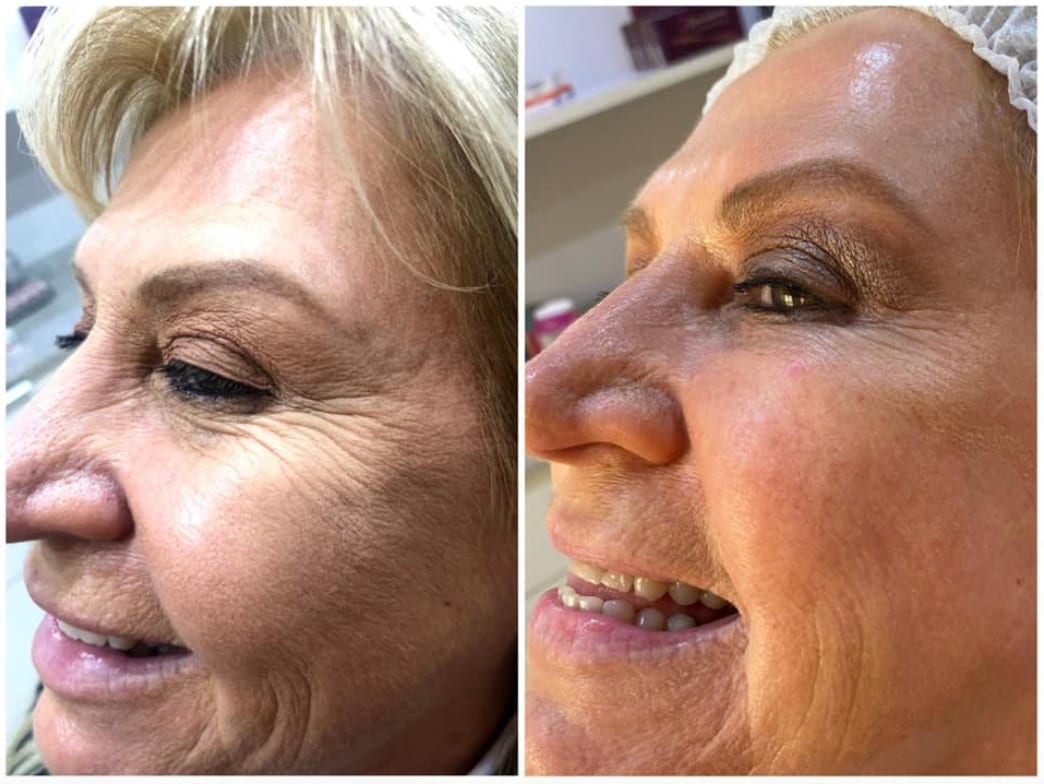 Antes e depois de tratamento em rosto com rugas usando ácido hialurônico