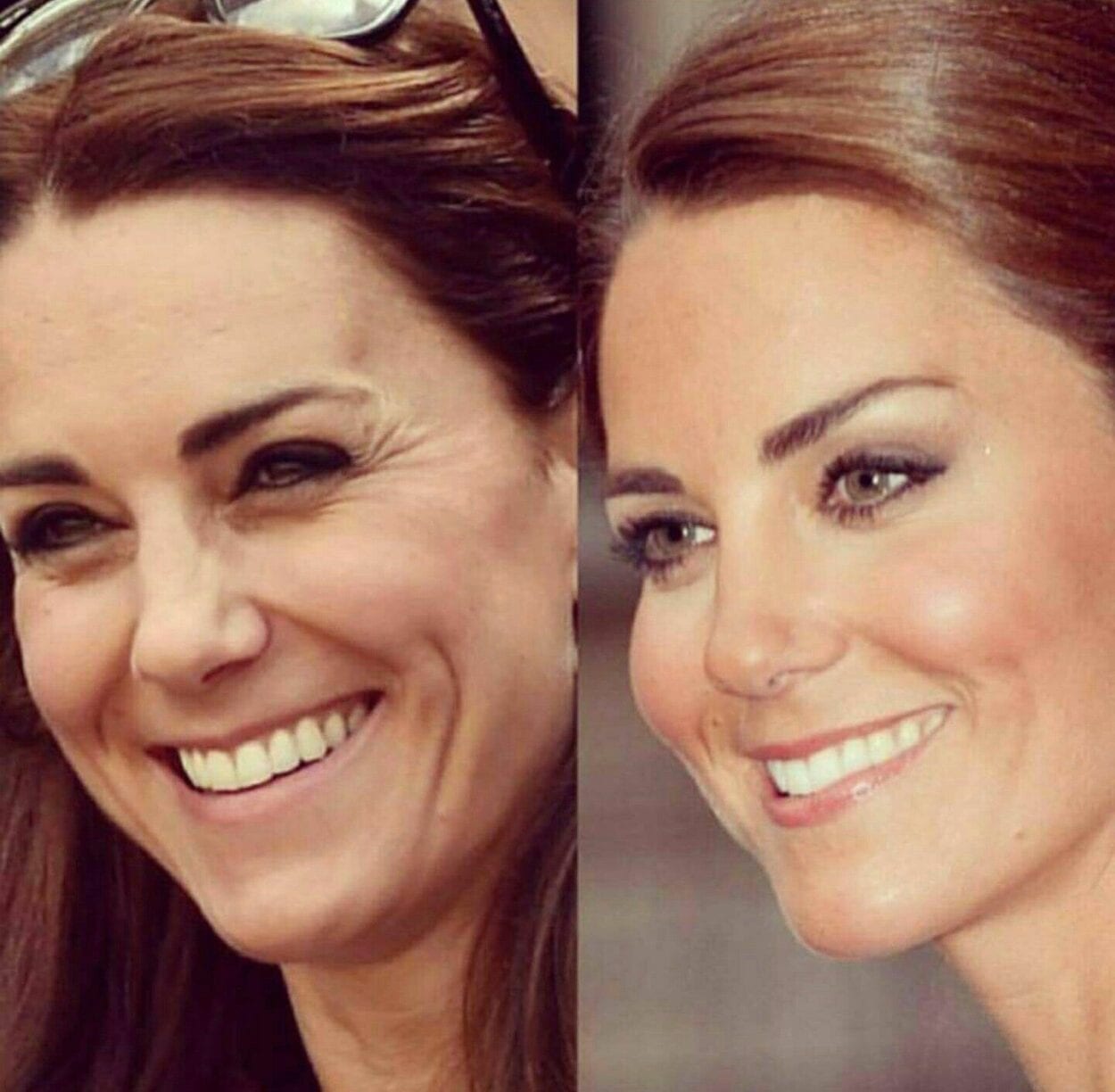 Kate Middleton em antes e depois dos procedimentos estéticos