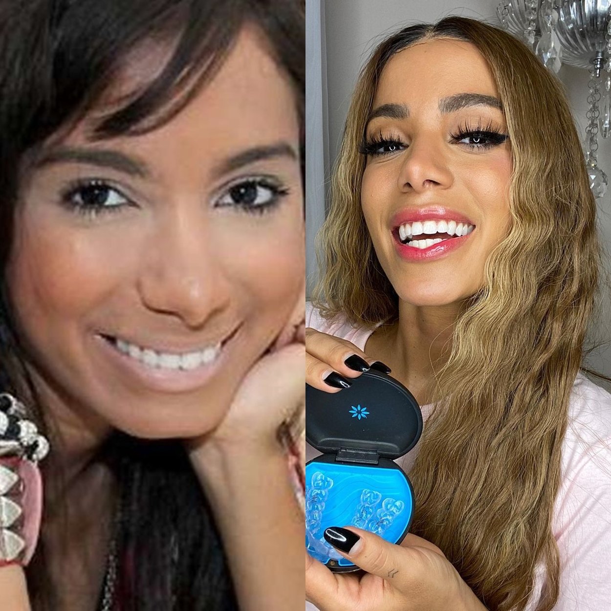 Anitta antes e depois da fama e das plásticas.