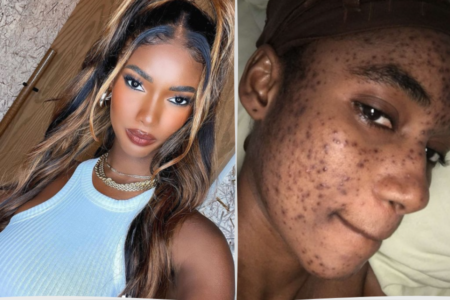 Participante do Miss Mundo está processando marca de beleza, cujo produto desfigurou seu rosto