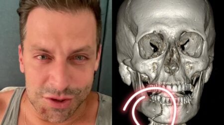 Henri Castelli sofre agressão e mostra raio X de mandíbula quebrada
