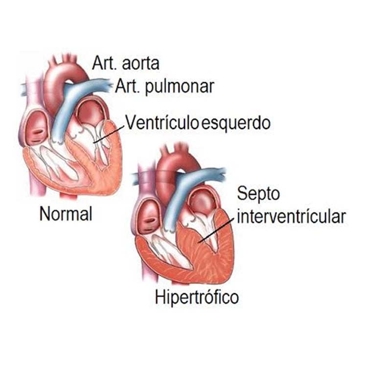 O que é a miocardiopatia hipertrófica? - Imagem meramente ilustrativa.