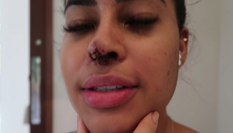 Sthe Matos mostrou a situação de seu nariz após duas cirurgias no nariz (Foto: Reprodução/Youtube)