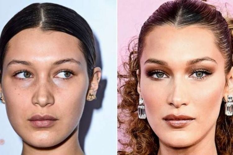 A modelo Bella Hadid antes e depois da harmonização facial