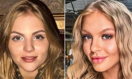 Harmonização facial: como é feito o procedimento? Veja antes e depois dos famosos!
