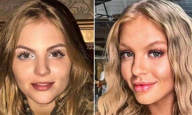 Harmonização facial: todas as suas dúvidas sobre o tema!