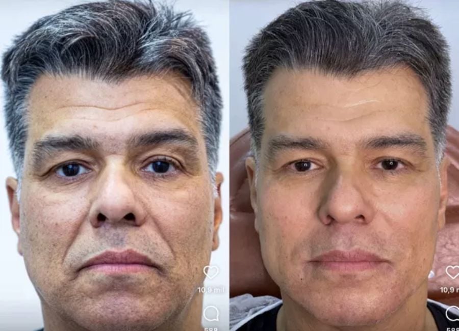 Na foto à esquerda, Mauricio Mattar aparece antes da harmonização facial. À direita, ele mostra o resultado do procedimento