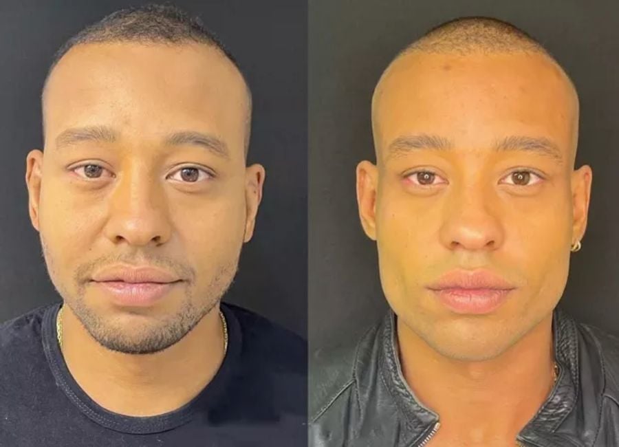 Na foto à esquerda, Mussunzinho aparece antes da harmonização facial. À direita, ele mostra o resultado do procedimento