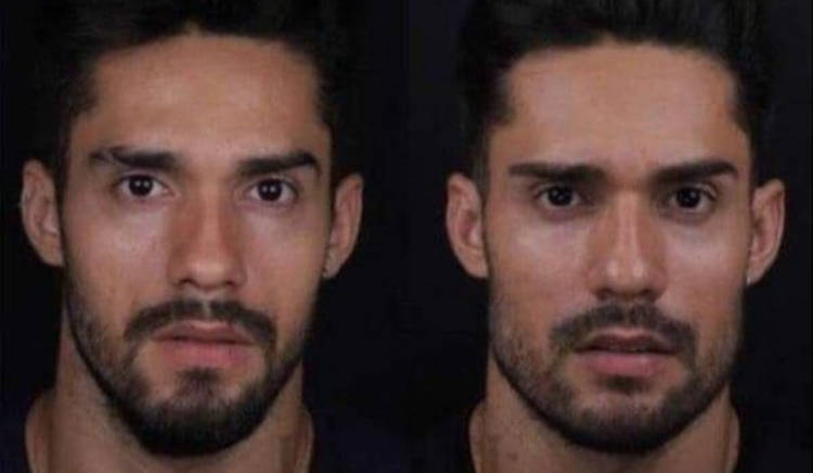 Bil araújo, antes e depois da harmonização facial