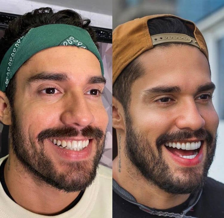 Bil Araújo antes e depois das lentes de contato