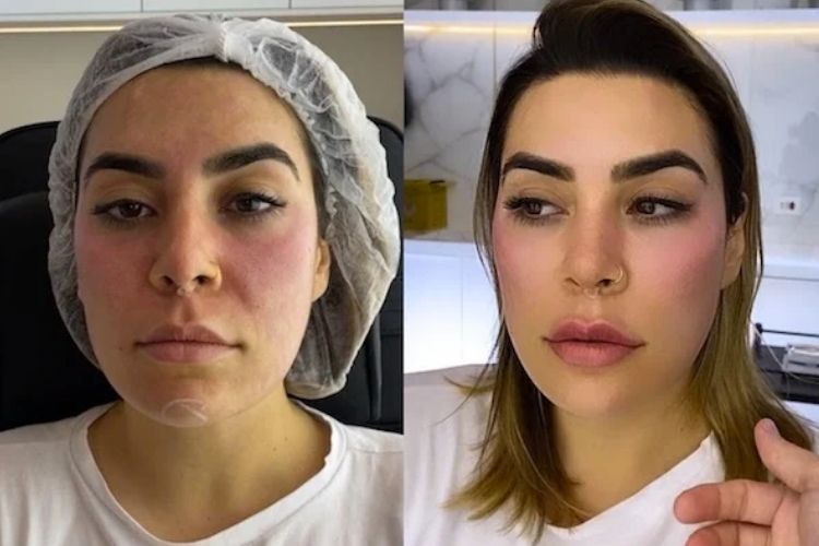Naiara Azevedo antes e depois da harmonização facial