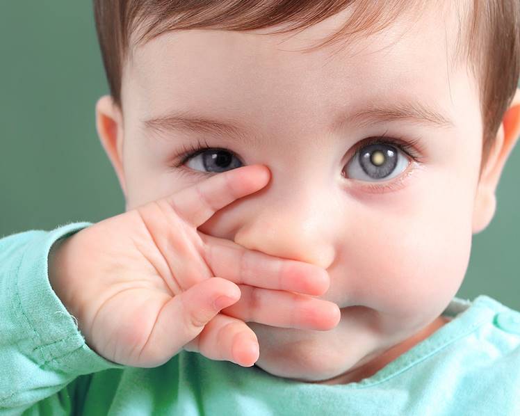 Foto de criança com retinoblastoma.