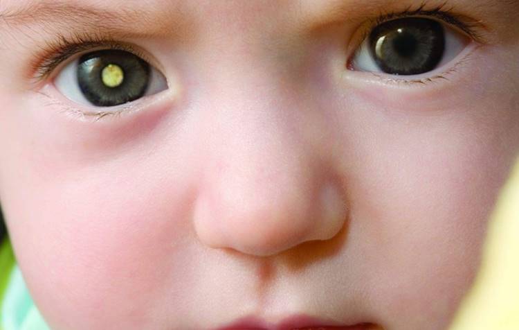 Foto de criança com retinoblastoma.
