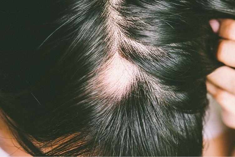 Truques de beleza mais pesquisados no Google: o que é alopecia?