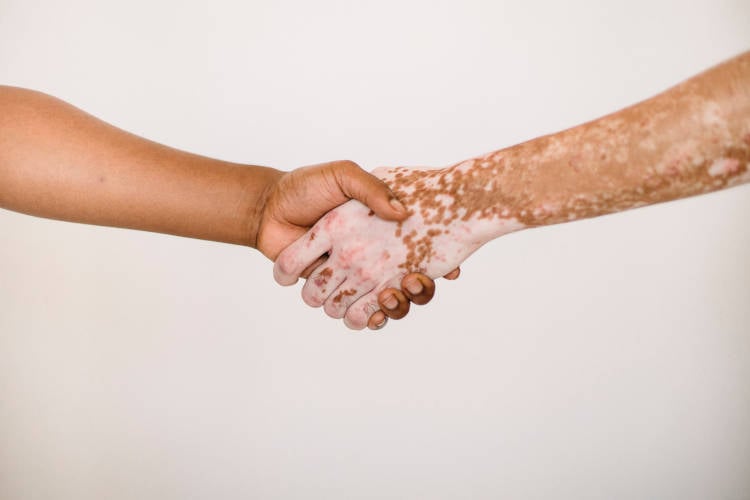 Duas pessoas apertando a mão, sendo que uma tem vitiligo.