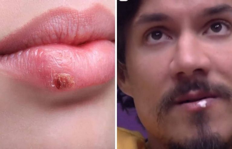 Herpes labial.