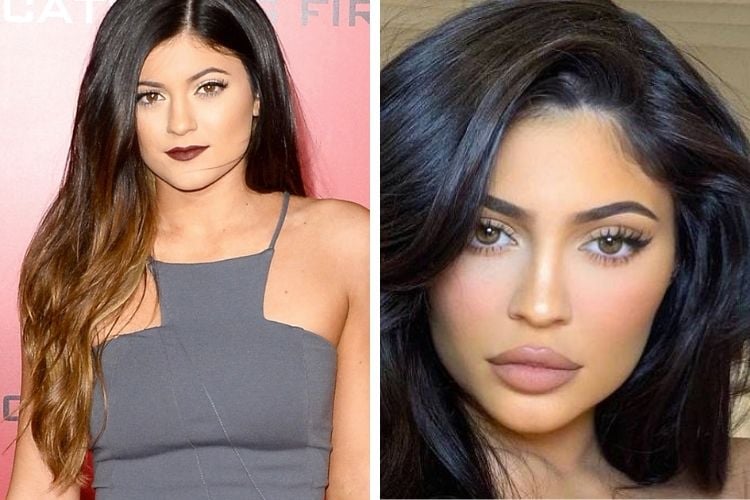 Kylie Jenner antes e depois da harmonização orofacial