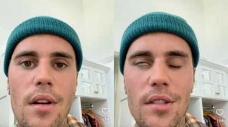 Justin Bieber sofre com síndrome rara e aparece com metade do rosto paralisado