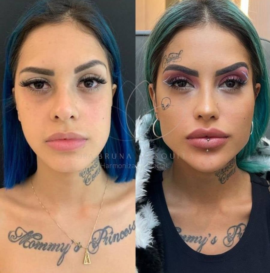 Antes e depois da Harmonização Facial de Tati Zaqui
