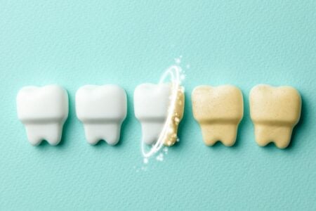 Clareamento dental: como funciona?