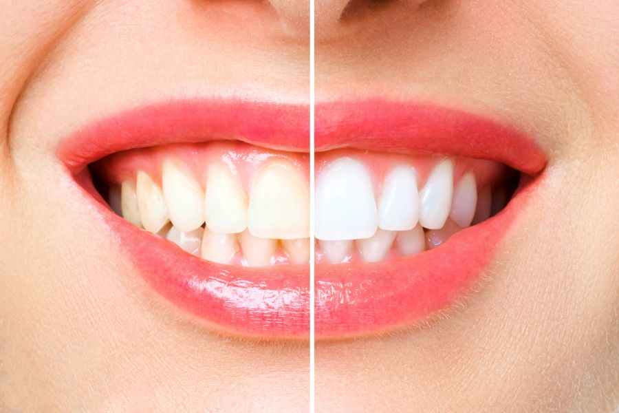 sorriso de mulher antes e depois de clareamento dental