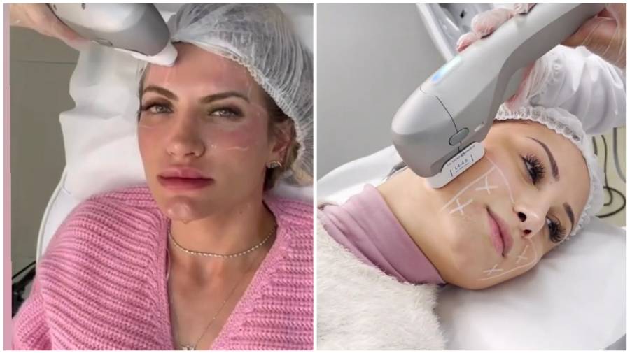 montagem com foto de duas mulheres passando por aplicação de Ultraformer 3 no rosto, tratamento para flacidez na pele