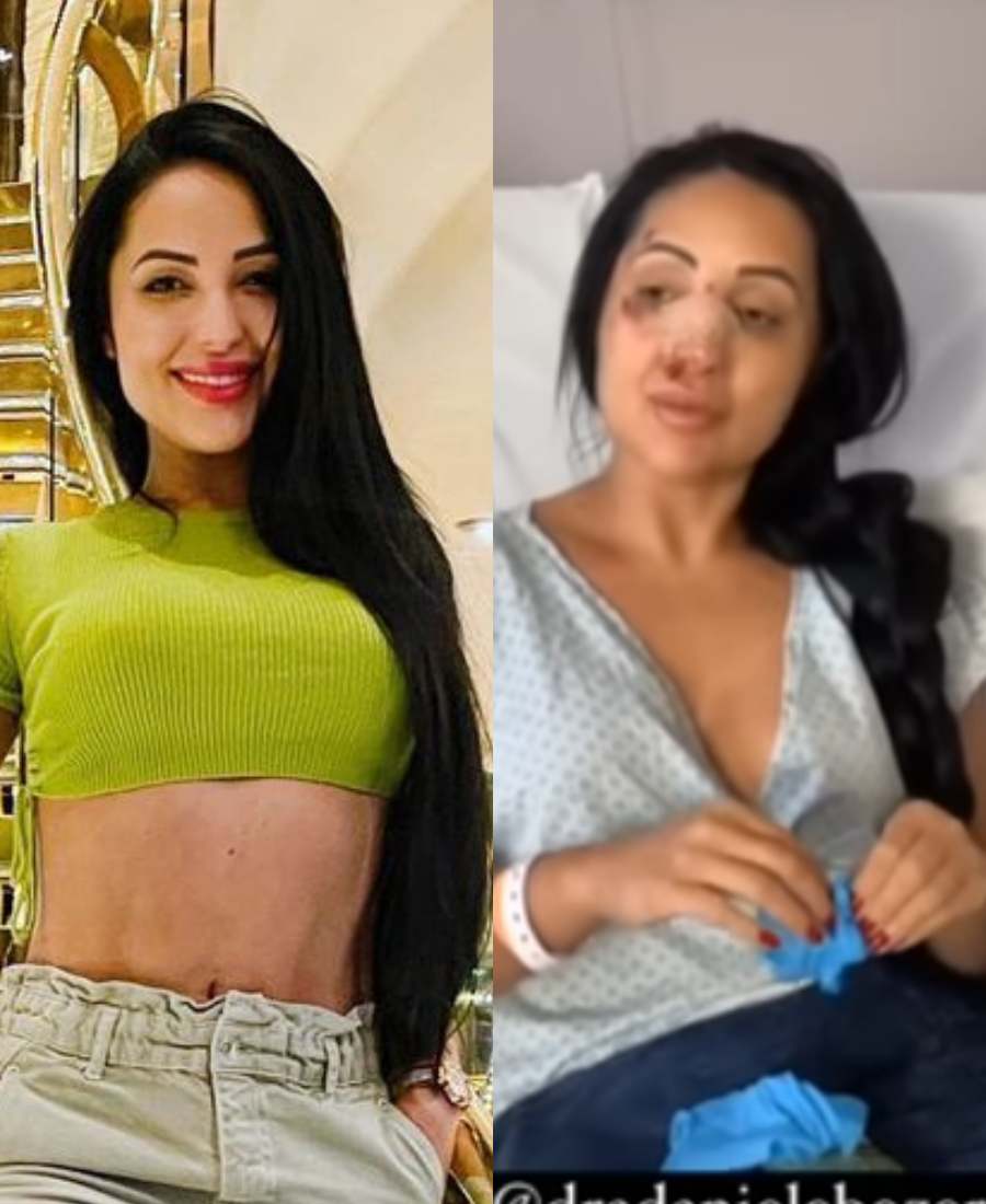 Foto antes e depois de Daniele Bezerra, irmã de Deolane Bezerra de A Fazenda, após briga em bar.