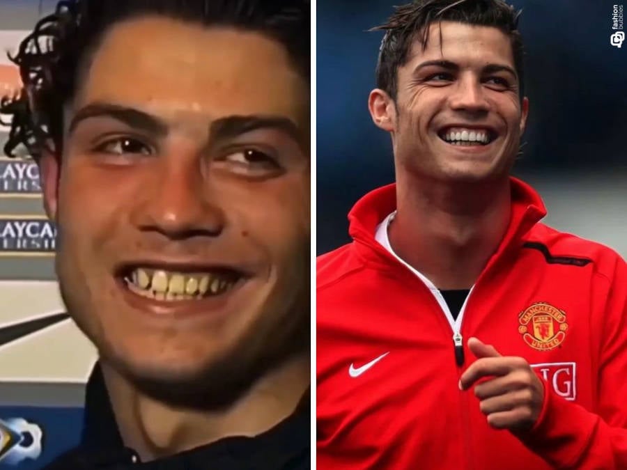 Foto de Cristiano Ronaldo antes e depois de consertar os dentes 