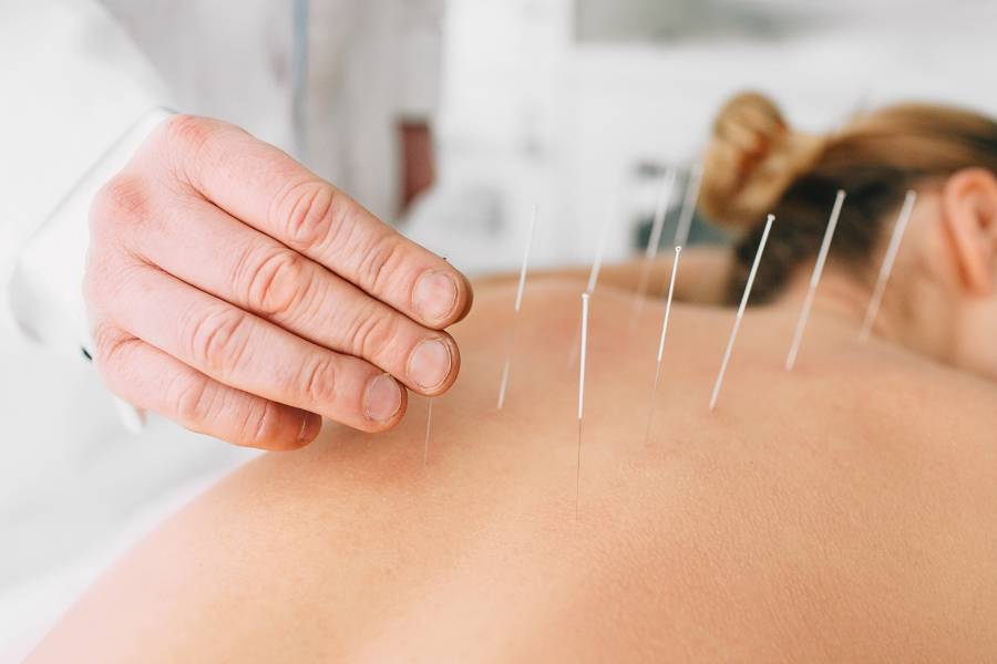Mulher fazendo acupuntura com agulhas nas costas.