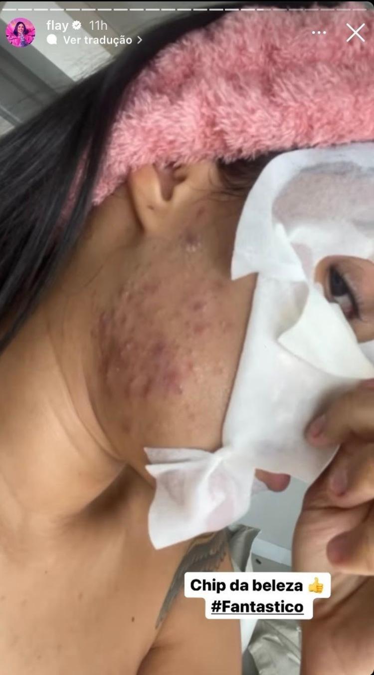 cantora Flay mostrando acnes no rosto