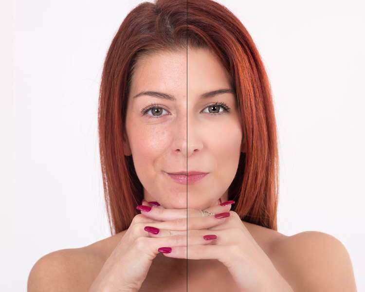 Antes e depois de rosto de mulher que fez procedimento com toxina botulínica