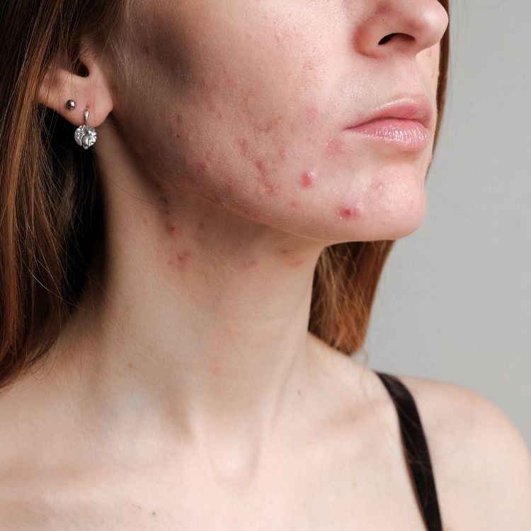 rosto de mulher com acnes na região do maxilar