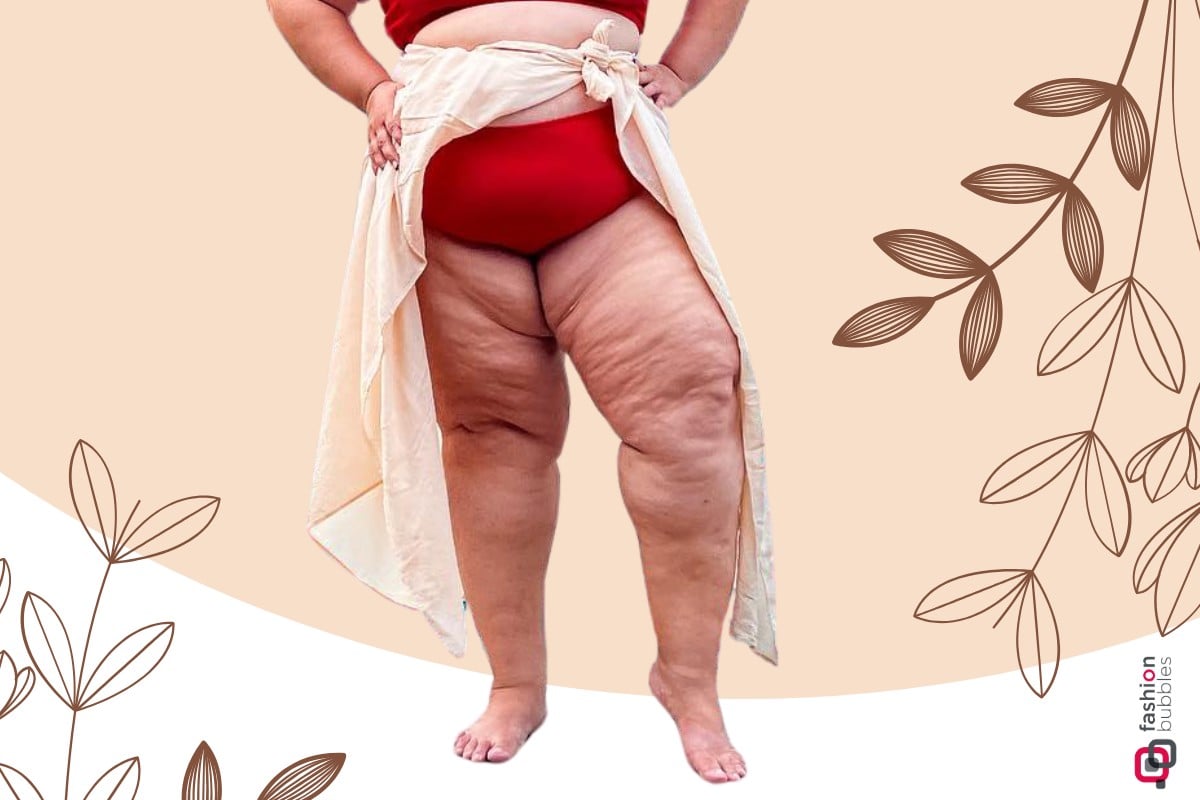 Lipedema: acúmulo desproporcional de gordura nas pernas tem