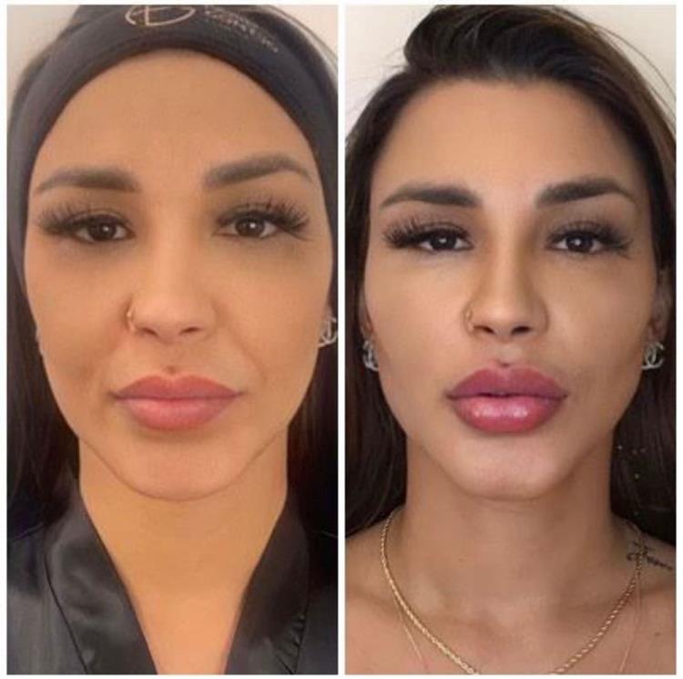 Jenny Miranda antes e depois de procedimento estético
