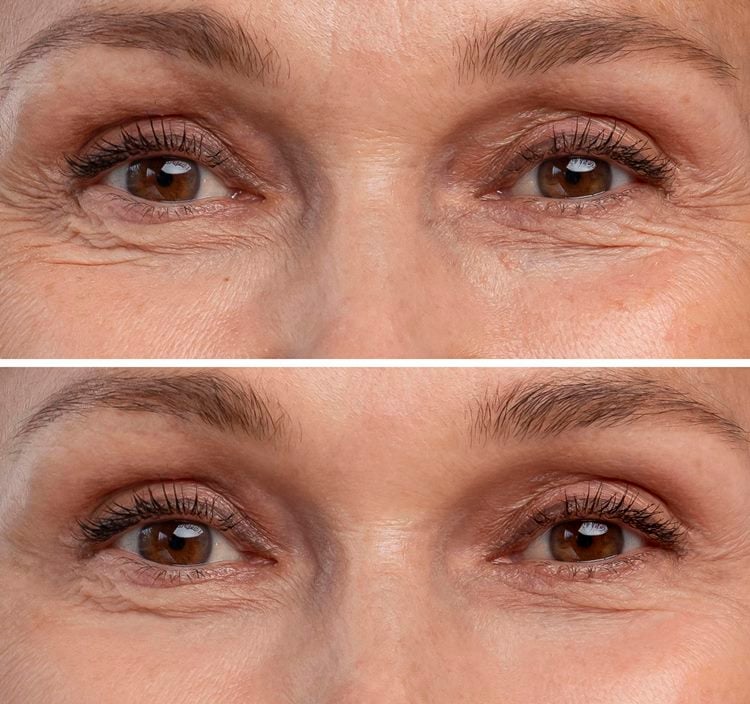 Blefaroplastia antes e depois. Foto de olhos de mulher, antes e depois do procedimento cirurgico