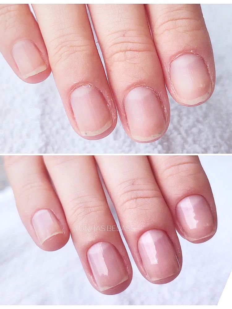 Antes e depois de cutículas de unhas