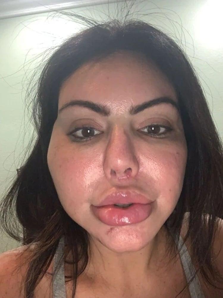 Liziane fez uma harmonização facial mal sucedida em 2018
