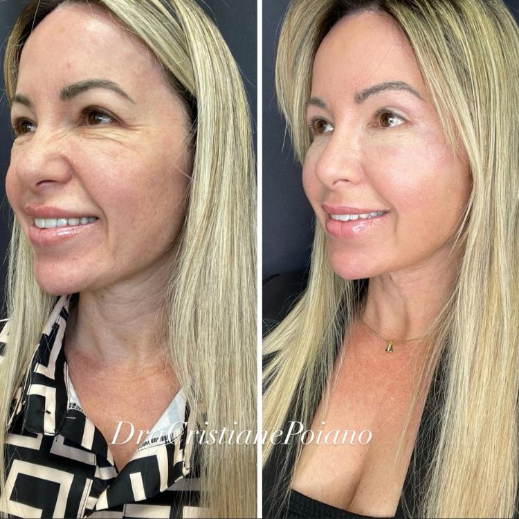 Foto de antes e depois de peeling de fenol em mulher de pele clara e loira, que apresentava rugas e manchas vermelhas e não apresenta mais