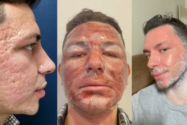 Foto de antes, durante e depois de tratamento de peeling de fenol em homem de pele clara. A prrimeira foto apresenta o homem com cicatrizes no rosto, a segunda com rosto vermelho e descamado e a terceira com rosto sensível mas sem cicatrizes