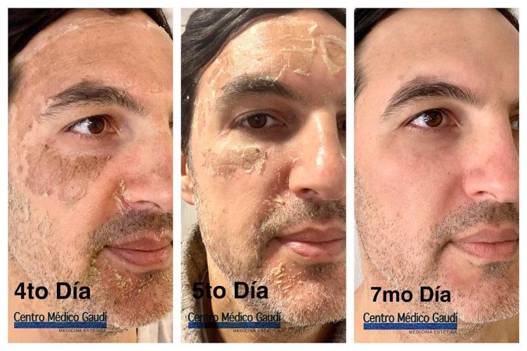 Três fotos de homem de pele clara em eovlução após peeling de fenol, com pele descamando e resultado de pele lisa