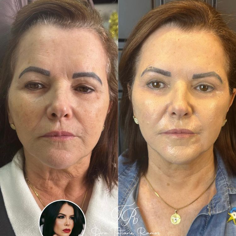 Antes e depois de peeling de fenol em mulher de pele clara e cabelo castanho, que apresentava manchas, rugas e linhas de expressão, suavizadas pelo tratamento