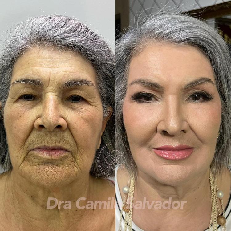 Antes e depois de peeling de fenol em senhora de cabelos brancos. Antes, ela apresentava muitas rugas e linhas de expressão, que sumiram após o procedimento