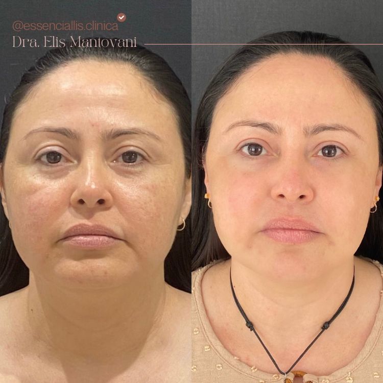 Fotos de antes e depois de peeling de fenol em mulher de pele clara, cujas rugas e linhas de expressão diminuíram