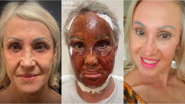 Montagem de antes, durante e depois de tratamento de peeling de fenol em mulher loira de pele clara. A primeira foto mostra a senhora com rugas e manchas, a segunda mostra a pele vermelha com escamas e a terceira mostra a mulher com pele rejuvenescida